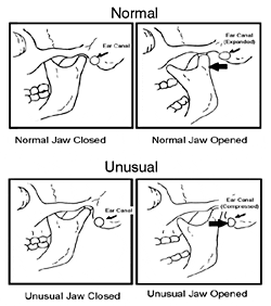 The Dynamic Ear Canal and Its Implications The Hearing Review