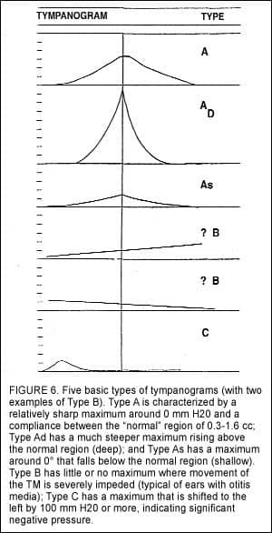 What is tympanometry?