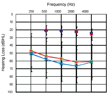 Language Progress of Children Using Advanced Hearing Aids: A Multisite Clinical Research Project Report