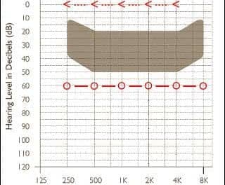 Overcoming Conductive/Mixed Hearing Losses and Single-Sided Deafness with Bone-Anchored Hearing Devices