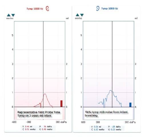 A diagram for plotting findings for tympanometry and acoustic