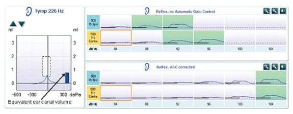 A diagram for plotting findings for tympanometry and acoustic