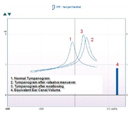 A diagram for plotting findings for tympanometry and acoustic