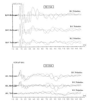 etiology of auditory neuropathy spectrum disorder