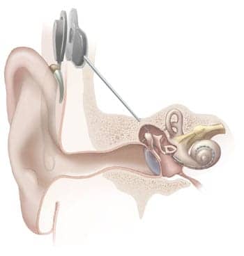 Trends In Cochlear Implants An Interview With Dr Ingeborg Hochmair Worldwide Ceo And Founder Of Med El Hearing Review