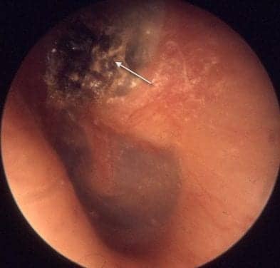 Study Shows That Pathology Tests Not Needed for Middle Ear Cyst Removal