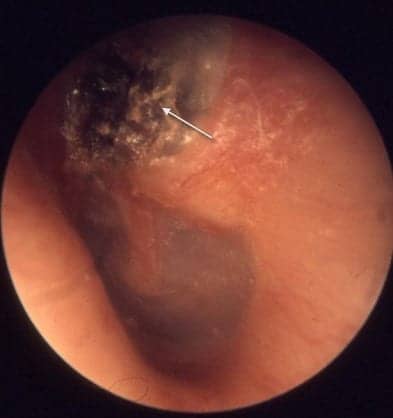 Study Shows That Pathology Tests Not Needed for Middle Ear Cyst Removal