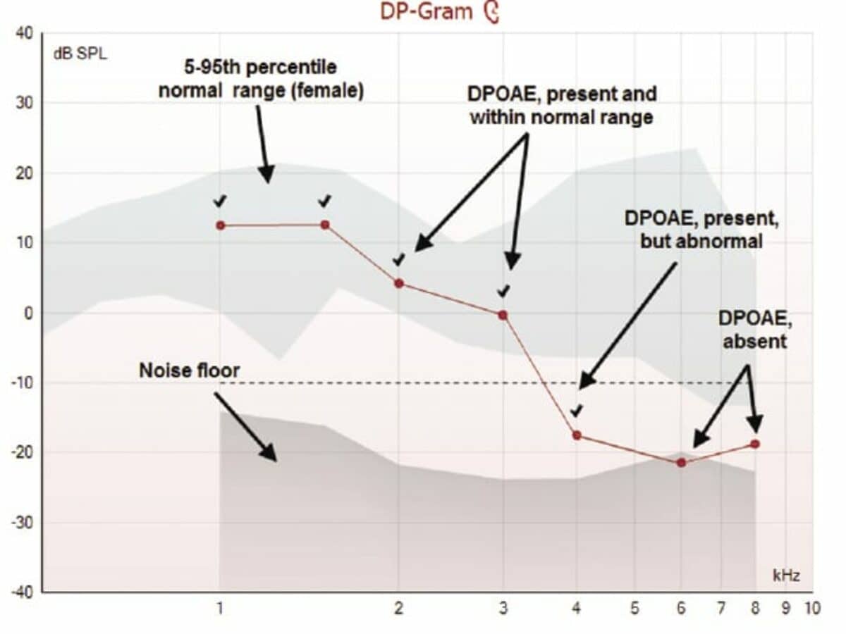 An Overview of OAEs and Normative Data for DPOAEs | The Hearing Review