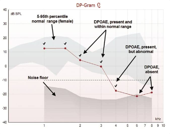 Acoustic Immittance in children without otoacoustic emissions