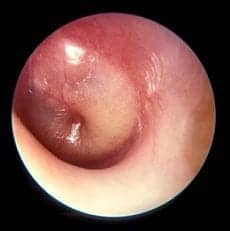 Newer Vaccines Have Significantly Reduced Ear Infections