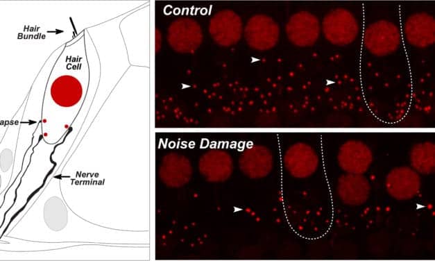 Noise-Induced “Hidden Hearing Loss” Mechanism—Nerve Fiber Loss— Presented at ASA Meeting