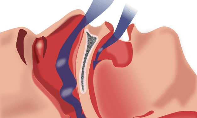 Sleep Apnea Tied to Hearing Loss in Large Study