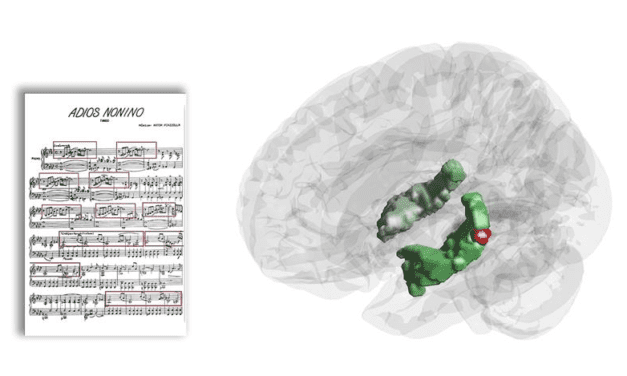 Hippocampal Activity While Listening to Music Shows Memory Activity