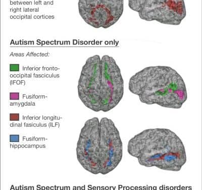 Kids with Autism, Sensory Processing Disorders Show Brain Wiring Differences