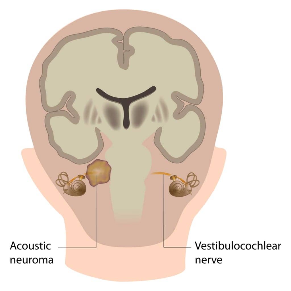 Acoustic Neuroma Diagram