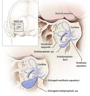 NIH Researchers Find DNA ‘Fingerprint’ Associated with Enlarged Vestibular Aqueduct