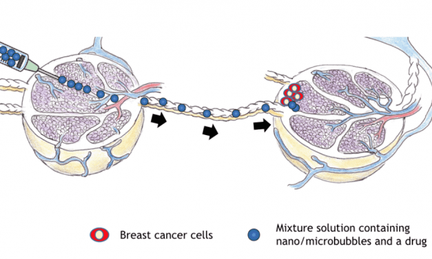 Researchers Deliver Breast Cancer Drug Via Sound Waves