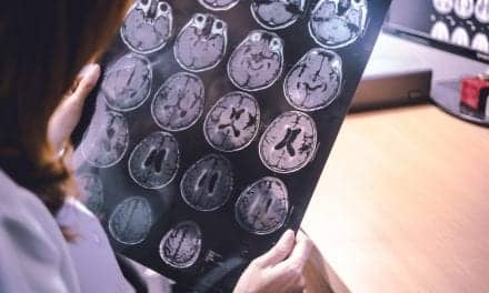 Cognitive Decline May Be Key in Life Expectancy with Alzheimer’s