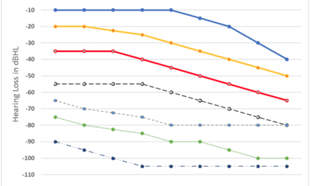 Real World Evidence on Gain and Output Settings for Individuals with Mild-to-Moderate Hearing Loss
