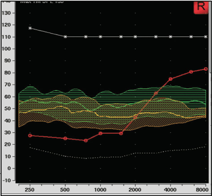 Starkey's AI Transforms Hearing Aids Into Smart Wearables - IEEE Spectrum