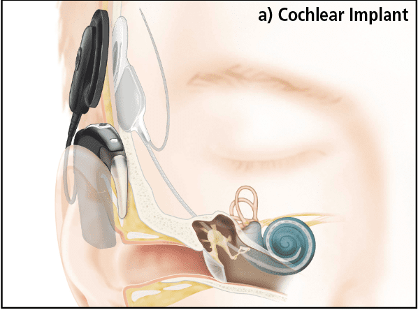 When Is an Implantable Hearing Solution Appropriate?