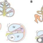 Cochlear Implants Linked to New Bone Formation