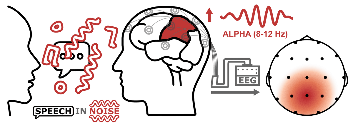 Split-processing in Hearing Aids Reduces Neural Signatures of Speech-in-Noise Listening Effort