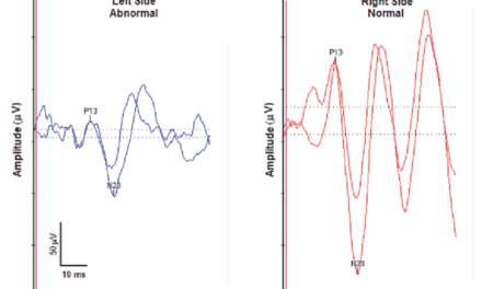 Part 2: Audiovestibular Symptoms Related to Migraine – What Audiologists and ENTs Need to Know in 2022 for Expanding Patient Care