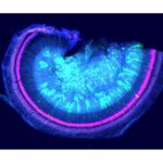 Steps Forward in Hearing Loss Gene Therapy Linked to Rare Disease