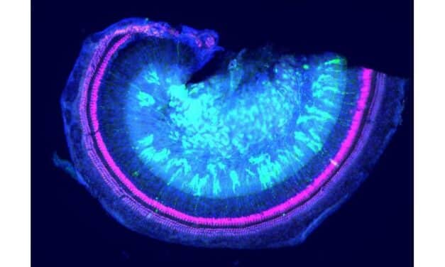 Steps Forward in Hearing Loss Gene Therapy Linked to Rare Disease