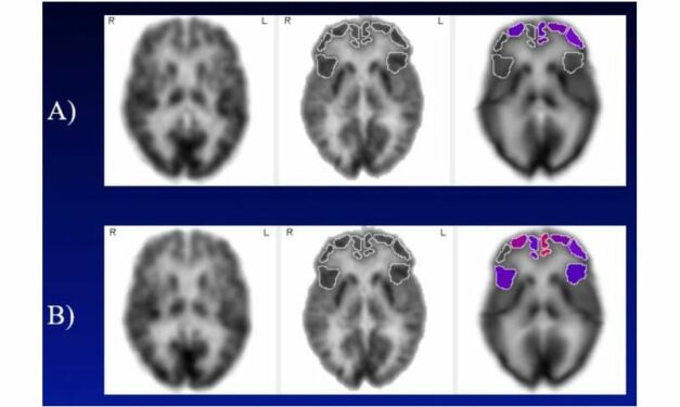 Hearing Aids Slow Brain Metabolic Decline in Adults with Mild Cognitive Impairment