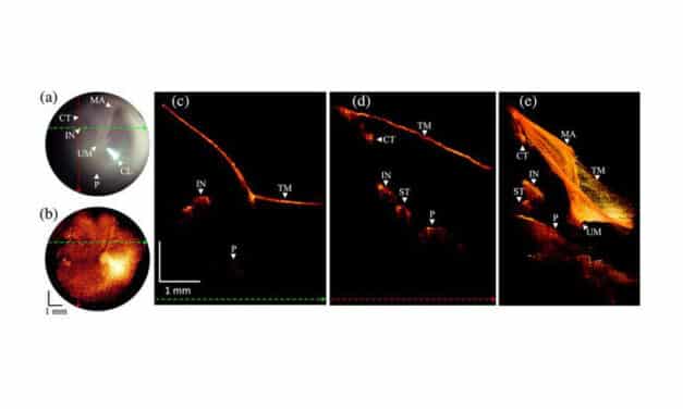 New Imaging Device Improves Ear Disease Diagnosis