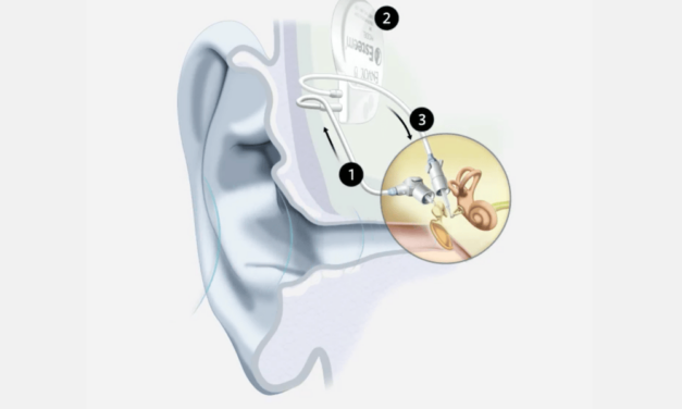 AMA Approves CPT Codes for Totally Implantable Active Middle-Ear Hearing Implants