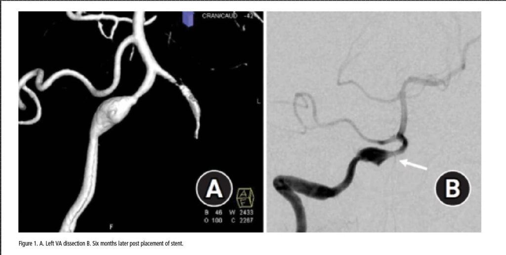 Figure 1. A. Left VA dissection B. Six months later post placement of stent.