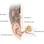 Med-El Totally Implantable Cochlear Implant (TICI) Feasibility Study Results Promising
