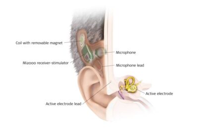 Med-El Totally Implantable Cochlear Implant (TICI) Feasibility Study Results Promising
