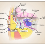 Flexible Hearing Device a Possible Implant Alternative