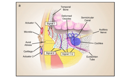 Flexible Hearing Device a Possible Implant Alternative