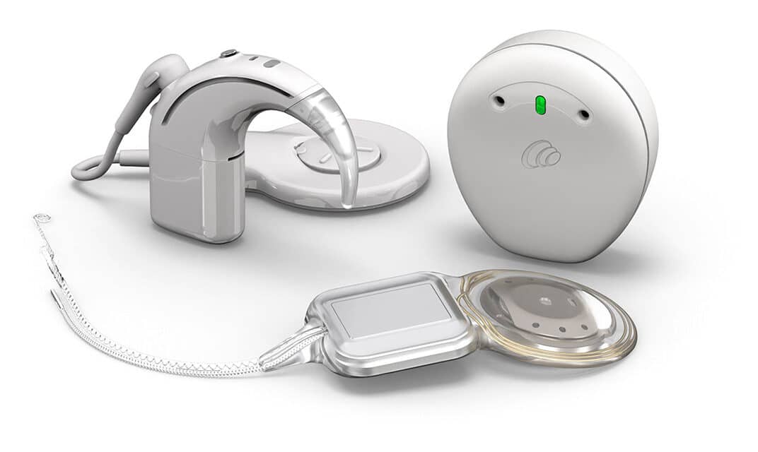 Cochlear Launches Smart Cochlear Implant System
