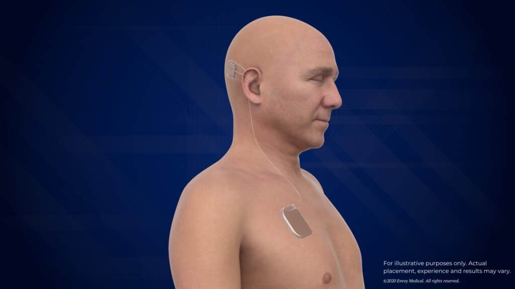 One major difference in the design of Envoy Medical’s Acclaim fully implanted cochlear implant is that its battery is implanted in the chest, connected to the processor via a lead.