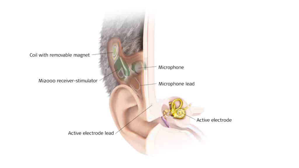 Med-El’s totally implantable cochlear implant system, or TICI, is built upon much of the same technology found in the company’s traditional CIs, but utilizes a new subcutaneous microphone.