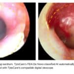 FDA Grants De Novo Classification to TytoCare’s AI Otoscopy Tool