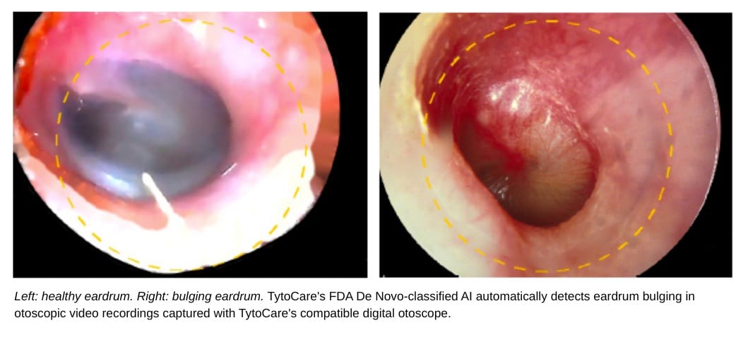 FDA Grants De Novo Classification to TytoCare’s AI Otoscopy Tool