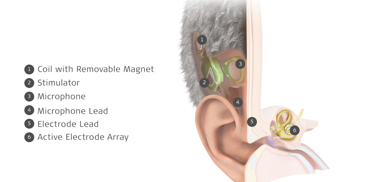 Med-El Launches TICI Unico, a Totally Invisible Cochlear Implant